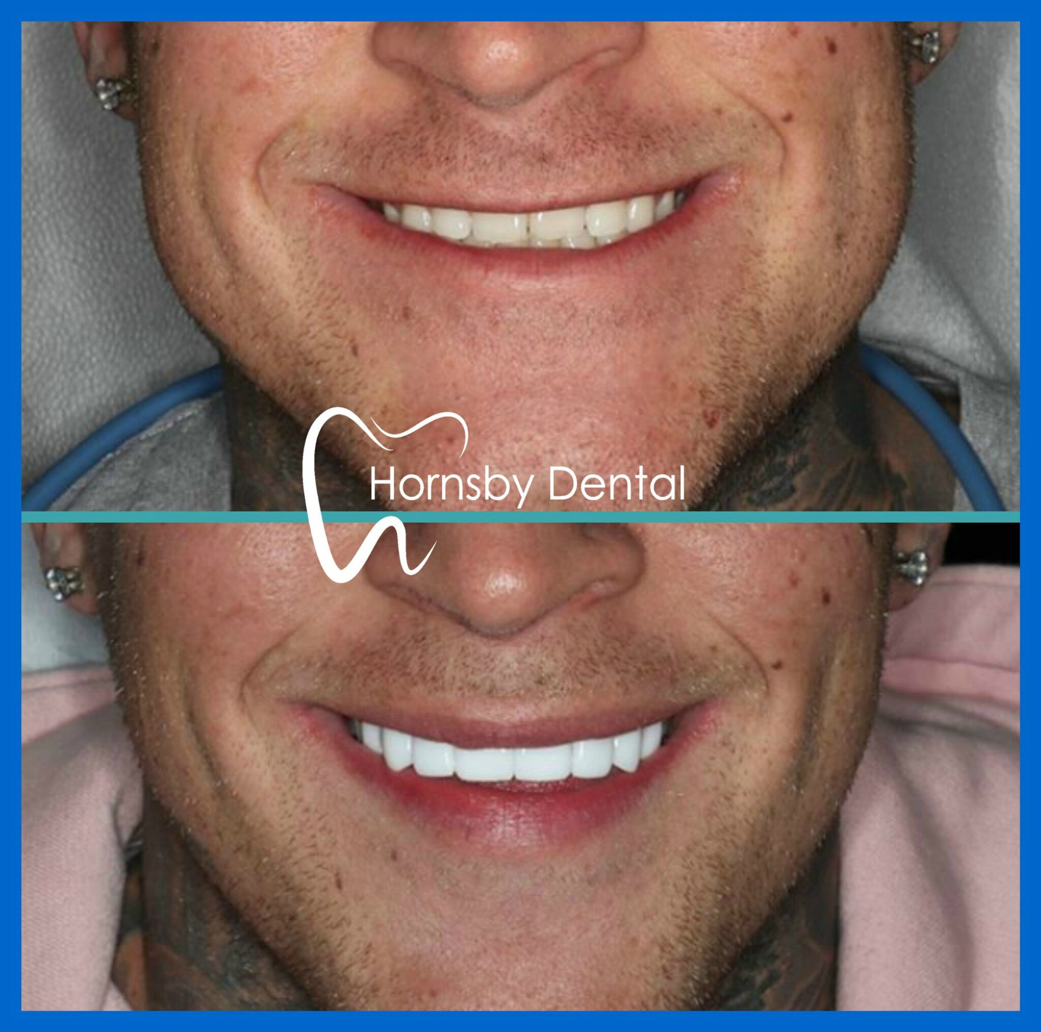 Emax BL1-LT prepless veneers 14-24