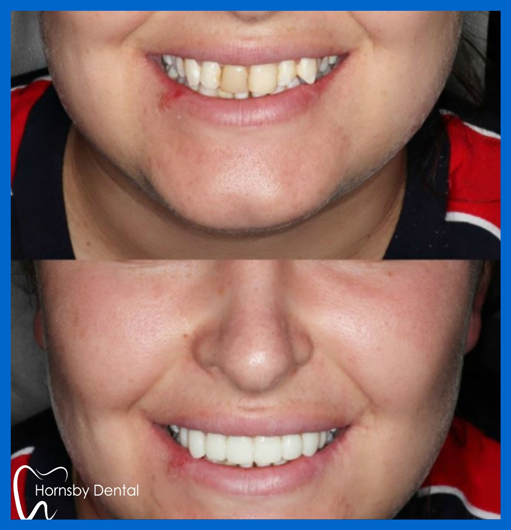 Estelite BW 14-24 veneers