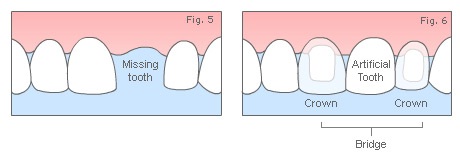 Hornsby-Dental-Bridge