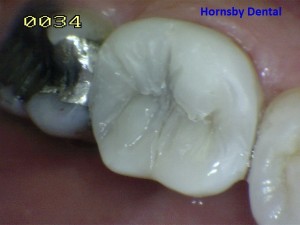 Hornsby-Dental-Case-5-After-Hornsby-Dentist-300x225