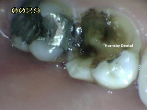 Hornsby-Dental-Case-5-Before-Hornsby-Dentist1-300x225