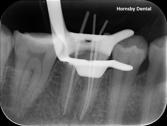 Hornsby-Dental-Root-Canal-Therapy-Measurement
