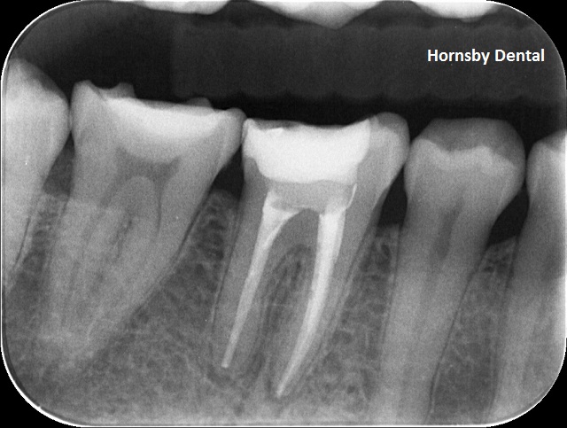 Hornsby-Dental-Root-Canal-Therapy-Post-op