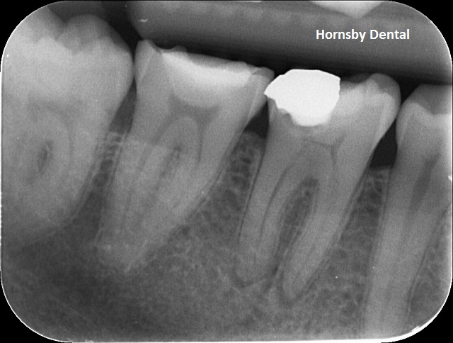 Hornsby-Dental-Root-Canal-Therapy-Pre-op