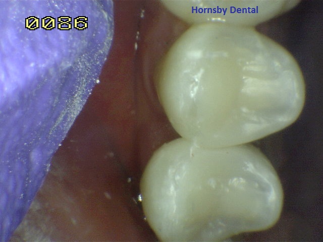 Hornsby-Dental_Root-Canal-Therapy_After
