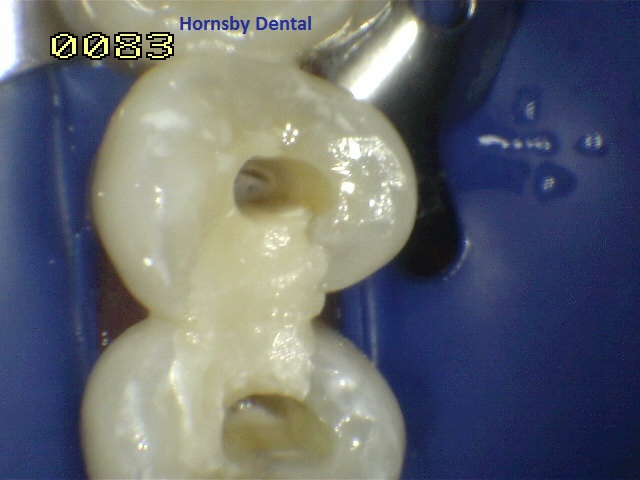 Hornsby-Dental_Root-Canal-Therapy_Before