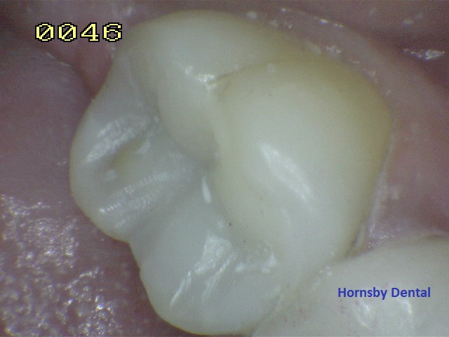 Hornsby_Cosmetic_Dentist_Case-8_After
