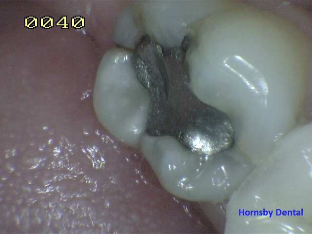 Hornsby_Cosmetic_Dentist_Case-8_Before