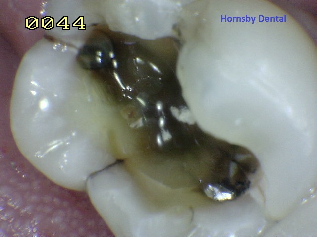 Hornsby_Cosmetic_Dentist_Case-8_During