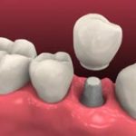 dental-implants-1-1-150x150