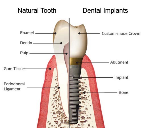 Dental Implants